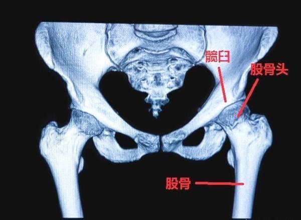 宝宝臀纹不对称一定是有问题的吗