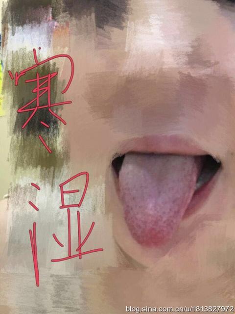 孩子体内湿气重怎么办