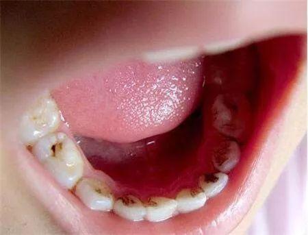 孩子蛀牙怎么办