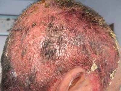 溢脂性脱发怎么治疗最彻