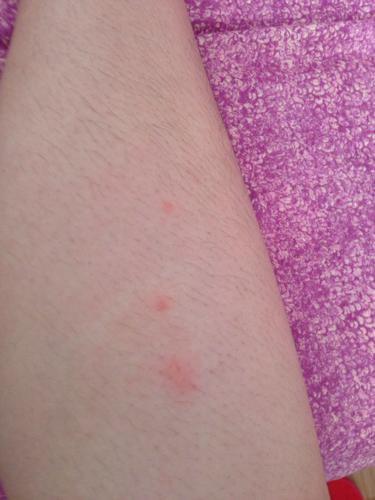 被蚊子叮了之后为什么会起红包