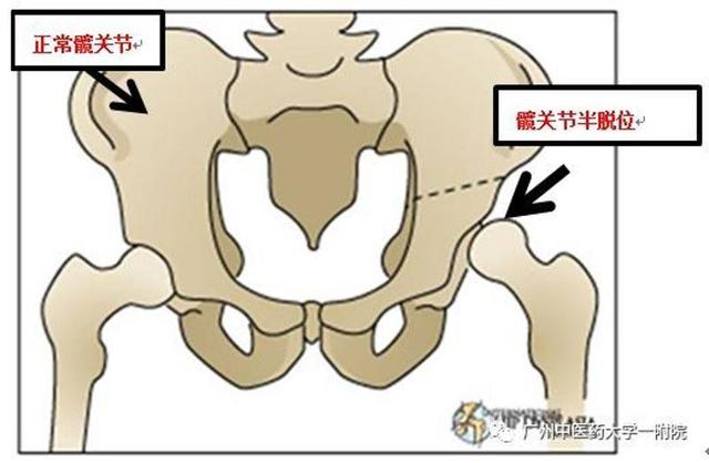 4个月宝宝髋关节发育不良怎么办