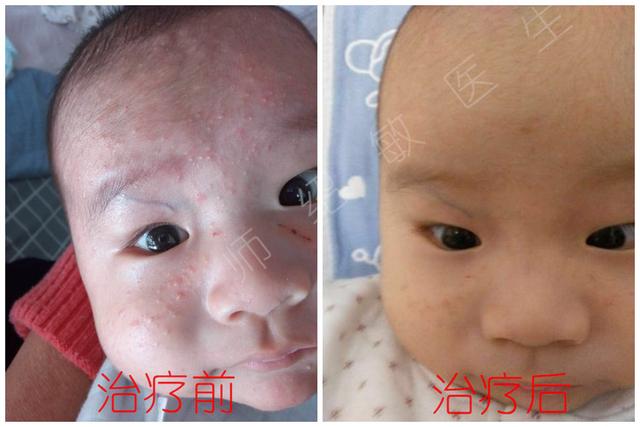 如何判断宝宝是湿疹还是皮肤炎