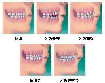 孩子蛀牙如何正确的清理牙齿