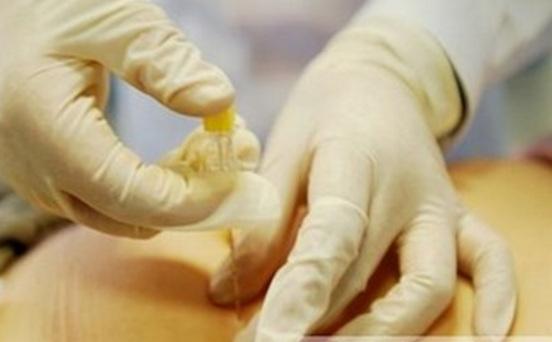 产后可以做埋线减肥吗