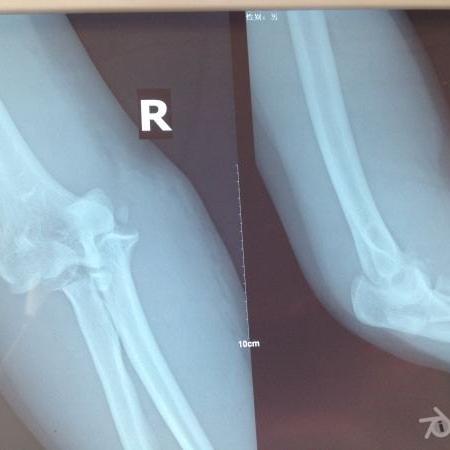 小儿肘关节复位手法图解 头条搜索
