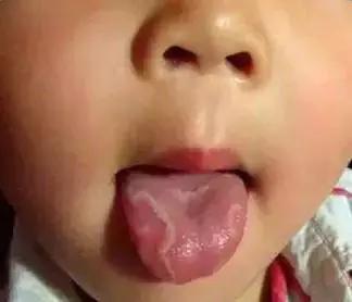 孩子舌头红了一块是上火吗