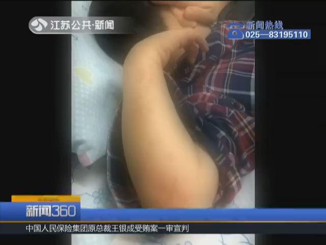 手足口病孩子痒痒如何缓解