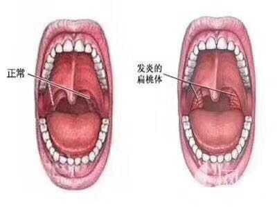 儿童腺样体肥大如何治疗