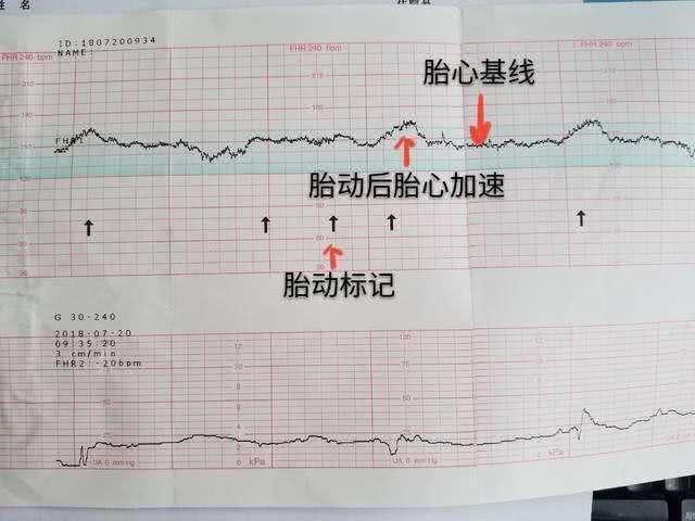 宫缩和胎动有什么不同