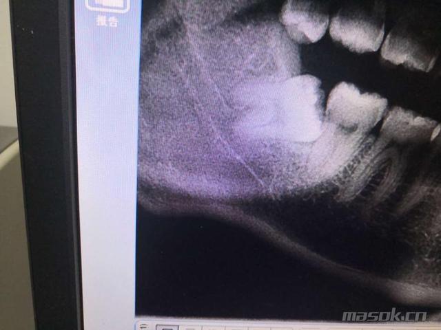 智齿能不能一次性拔4颗