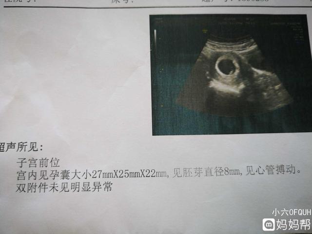 孕囊和胚胎的区别图