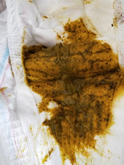 宝宝便秘不拉粑粑