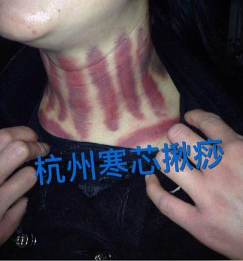 寒芯揪痧