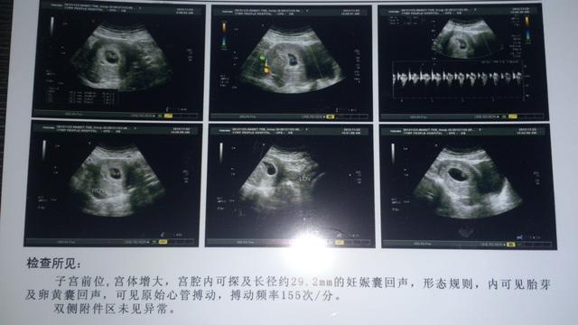 怀孕7周早孕反应突然消失正常吗