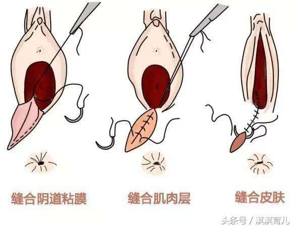 高危妊娠检测是什么