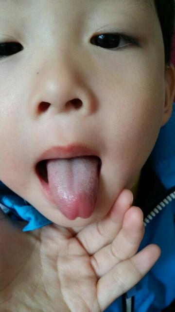 小孩发烧呕吐怎么护理