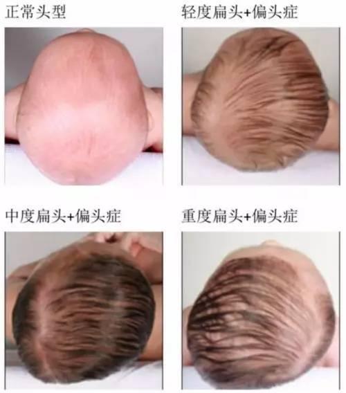宝宝喜欢歪头睡是怎么回事