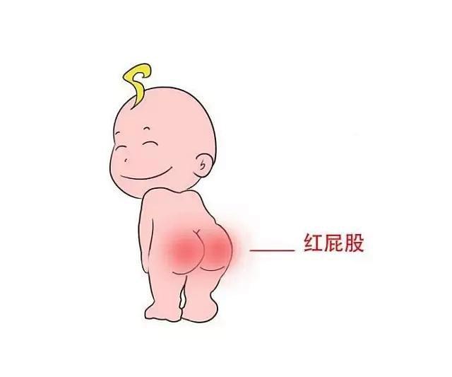 婴儿红屁股怎么回事?