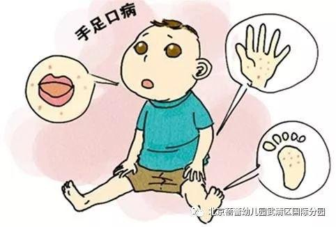 春季如何预防手足口病