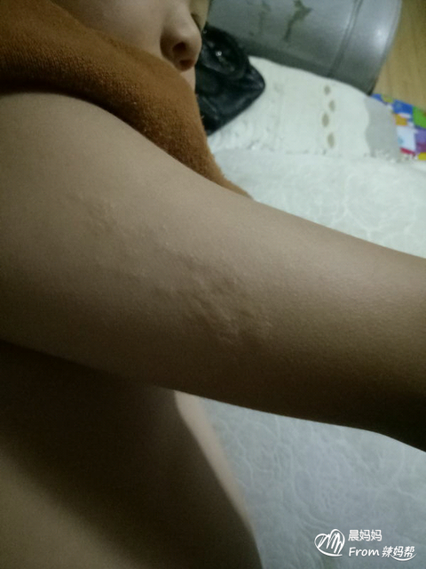 手足口病孩子痒痒如何缓解
