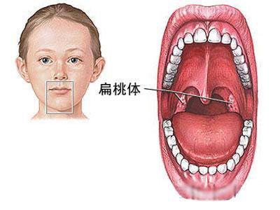宝宝扁桃体经常发炎是什么原因