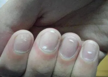 手指甲上有白点是什么原因，指甲上有白点的6种原因