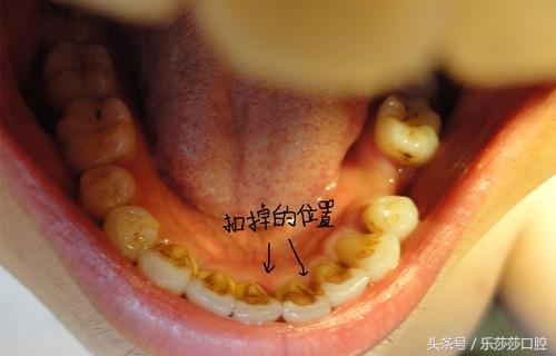 孩子牙齿黄黄的是怎么了孩子牙齿黄黄的怎么办