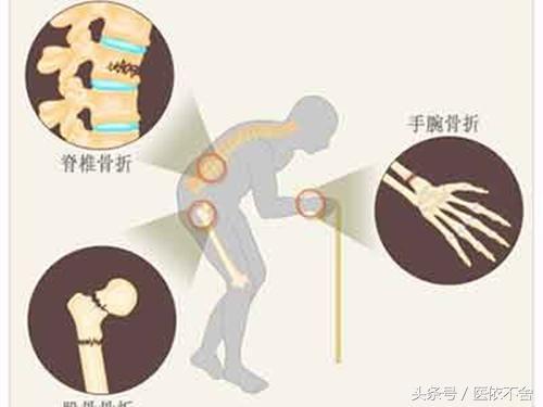 妊娠期更容易骨质疏松吗