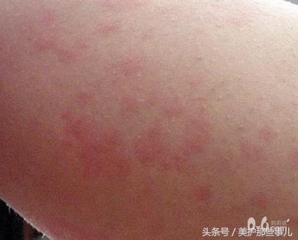 预防宝宝冬季皮肤瘙痒