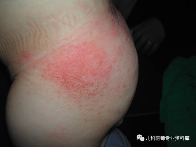 尿布性皮炎的预防和护理方法 尿布性皮炎的预防和护理方法