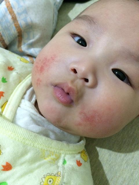 如何预防宝宝长口水疹