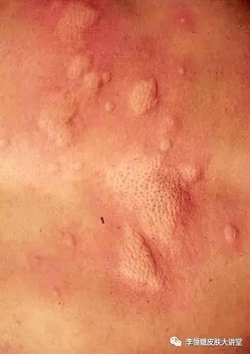 宝宝荨麻疹反复怎么办 宝宝荨麻疹反复怎么办