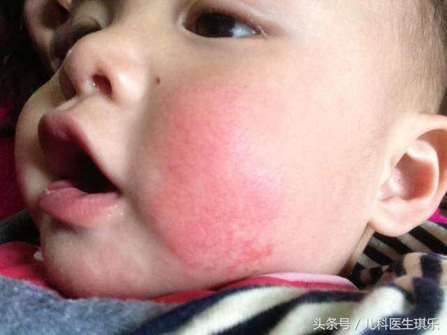 如何预防宝宝长口水疹