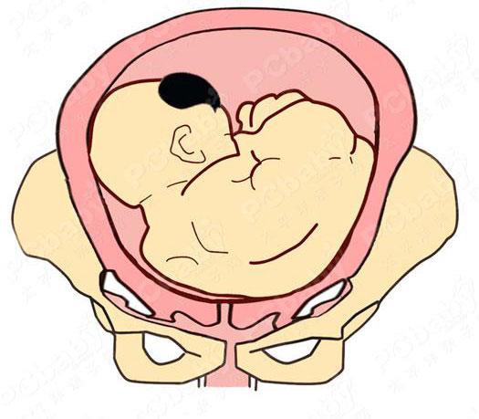 胎儿入盆后胎位还会变吗