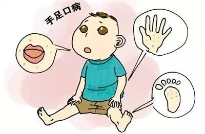 手足口病疫苗有必要打吗