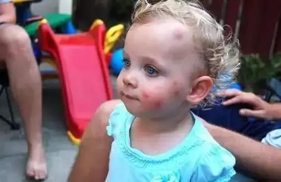 这些宝宝更容易招蚊子