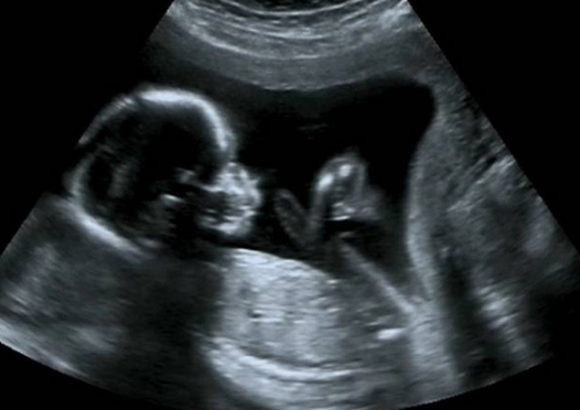 孕早期担心胎停或者胎儿发育不好，应该做什么检查呢