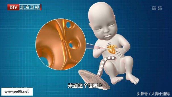 新生儿卵圆孔未闭合正常吗