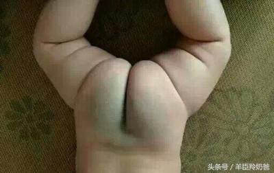 注意宝宝胎记