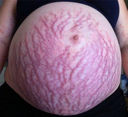 这4种孕妈可能不会长妊娠纹