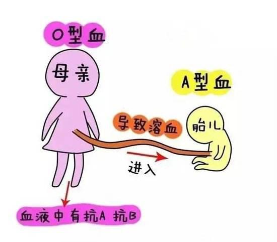 什么是ABO溶血及ABO溶血的成因