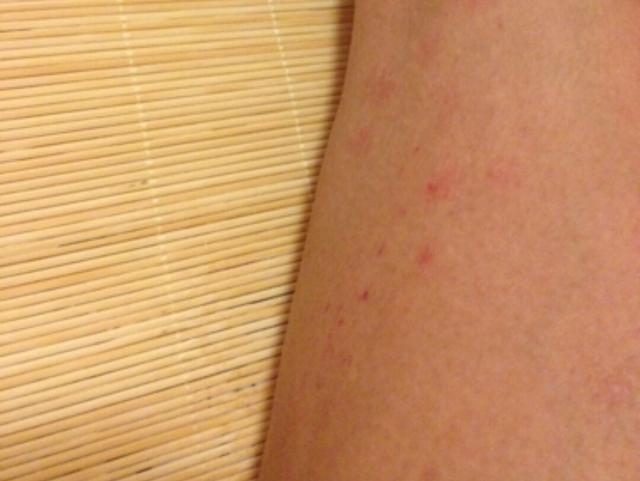 夏季到处痒怎么护理