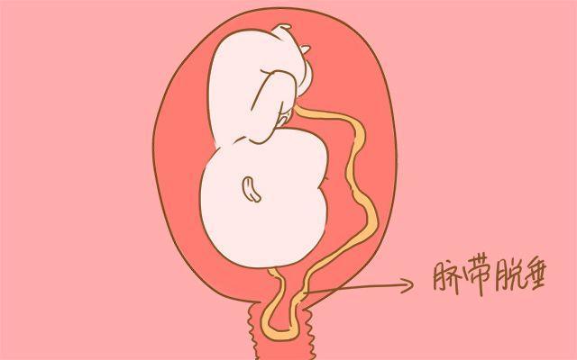 胎儿脐带异常有哪些危害