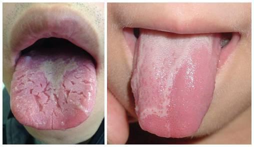 舌头异常情况:宝宝的舌头颜色比较淡,舌苔白色厚腻2.