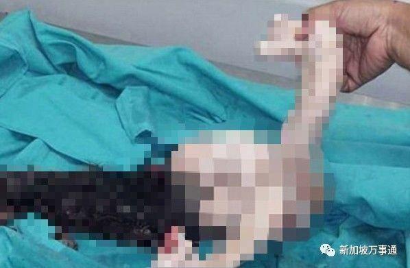 寄生胎是怎么形成的图片