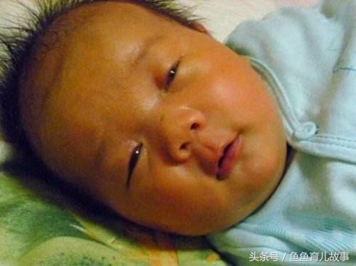 母乳性黄疸有哪些症状 母乳性黄疸有哪些症状