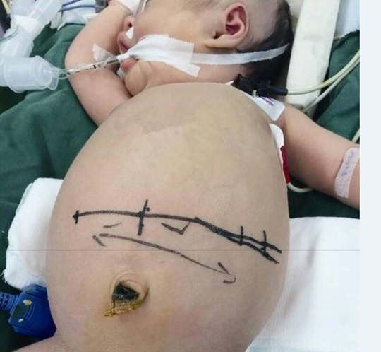 为什么剖腹产后要压肚子