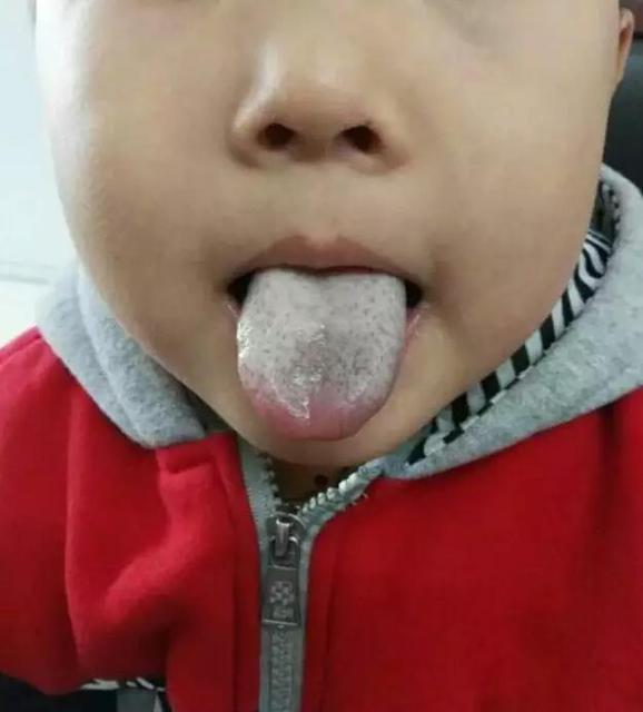 宝宝舌苔厚是怎么回事
