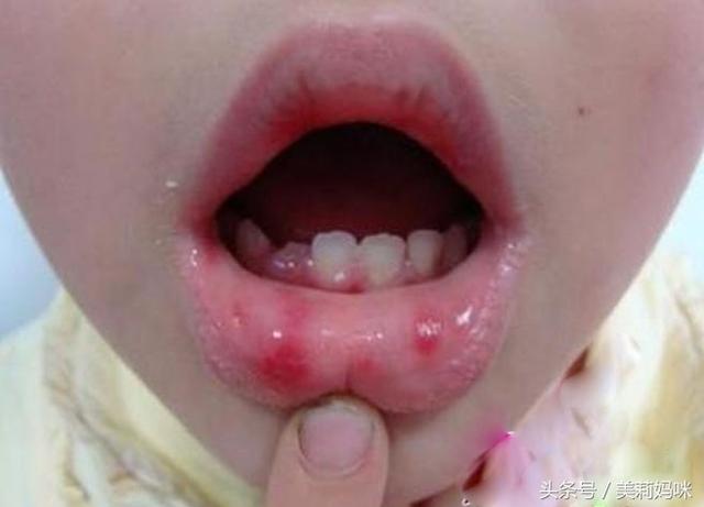 手足口病一般几天能好